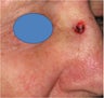 Mohs surgery defect repair