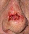 Mohs surgery defect of dorsum of the nose