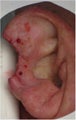 Right ear Mohs defect and repair