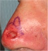Left nose post Mohs flap repair