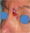 Repair of Mohs surgery defect on the left nose
