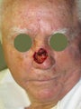 Moh's surgery nasal reconstruction