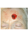 Skin cancer reconstruction