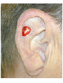 Skin cancer reconstruction on ear