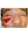 Sskin cancer reconstruction on the cheek