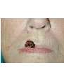 Lip skin cancer reconstruction