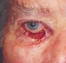 Eyelid skin cancer reconstruction