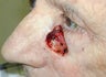 Eyelid and cheek skin cancer reconstruction