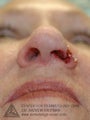 Mohs Surgery of Basal Cell Carcinoma and Recontruction