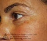 Mohs Surgery of Basal Cell Carcinoma and Recontruction