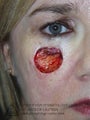 Mohs Surgery of Lentigo Maligna (Melanoma) and Reconstruction