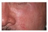 Mohs Surgery