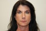 Forehead reconstruction after MOHS surgery and Left Brow Lift For Symmetry