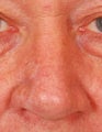 Nasal Reconstruction