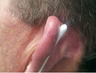 Skin Cancer Surgery on Ear