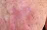 Skin Cancer Surgery on Hand