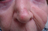 Skin Cancer Surgery on Nose