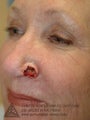 Mohs Surgery of Basal Cell Carcinoma and Recontruction