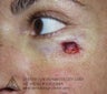 Mohs Surgery of Basal Cell Carcinoma and Recontruction