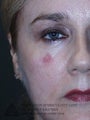 Mohs Surgery of Lentigo Maligna (Melanoma) and Reconstruction