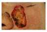Mohs Surgery