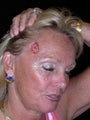 Forehead reconstruction following MOHS surgery for skin cancer