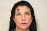 Forehead reconstruction after MOHS surgery and Left Brow Lift For Symmetry