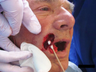 Mohs reconstruction of upper lip and commissure