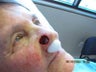 Before reconstruction, but after Mohs surgery