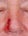 Nasal Reconstruction