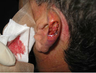 Skin Cancer Surgery on Ear