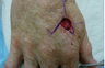 Skin Cancer Surgery on Hand