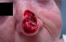 Skin Cancer Surgery on Nose
