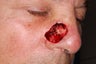 Mohs Surgery Repair
