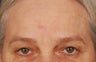 Mole Removal