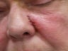 Basal Cell Carcinomas Excisions