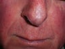 Basal Cell Carcinomas Excisions