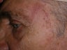 Basal Cell Carcinomas Excisions