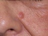 Basal Cell Carcinomas Excisions
