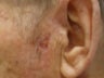 Basal Cell Carcinomas Excisions