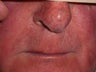 Basal Cell Carcinomas Excisions
