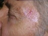Basal Cell Carcinomas Excisions