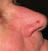 Skin cancer excision with skin graft repair