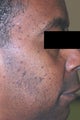 Los Angeles Mole Removal - Dermatosis Papulosa Nigra