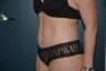 Tummy tuck