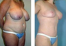 Mommy Makeover