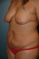 Breast lift and tummy tuck