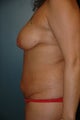 Breast lift and tummy tuck
