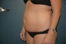 Tummy tuck
