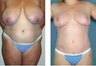 Mommy Makeover